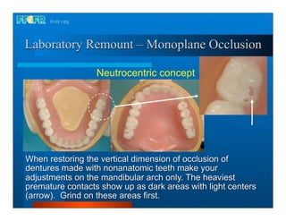 Laboratory Remount – Monoplane Occlusion

                  Neutrocentric concept




When restoring the vertical dimension of occlusion of
dentures made with nonanatomic teeth make your
adjustments on the mandibular arch only. The heaviest
premature contacts show up as dark areas with light centers
(arrow). Grind on these areas first.
 