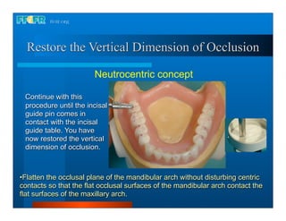 Restore the Vertical Dimension of Occlusion

                        Neutrocentric concept

 Continue with this
 procedure until the incisal
 guide pin comes in
 contact with the incisal
 guide table. You have
 now restored the vertical
 dimension of occlusion.



•Flatten the occlusal plane of the mandibular arch without disturbing centric
contacts so that the flat occlusal surfaces of the mandibular arch contact the
flat surfaces of the maxillary arch.
 