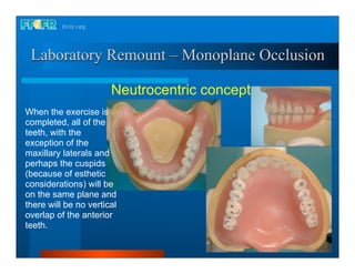 Laboratory Remount – Monoplane Occlusion

                       Neutrocentric concept
When the exercise is
completed, all of the
teeth, with the
exception of the
maxillary laterals and
perhaps the cuspids
(because of esthetic
considerations) will be
on the same plane and
there will be no vertical
overlap of the anterior
teeth.
 