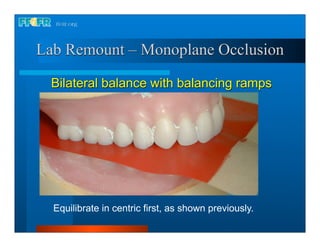 Lab Remount – Monoplane Occlusion

  Bilateral balance with balancing ramps




  Equilibrate in centric first, as shown previously.
 