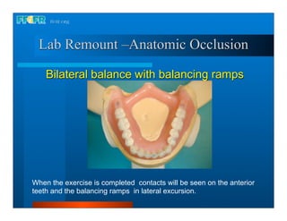 Lab Remount –Anatomic Occlusion

    Bilateral balance with balancing ramps




When the exercise is completed contacts will be seen on the anterior
teeth and the balancing ramps in lateral excursion.
 