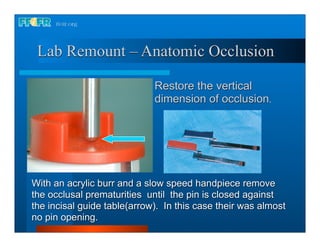 Lab Remount – Anatomic Occlusion

                             Restore the vertical
                             dimension of occlusion.




With an acrylic burr and a slow speed handpiece remove
the occlusal prematurities until the pin is closed against
the incisal guide table(arrow). In this case their was almost
no pin opening.
 