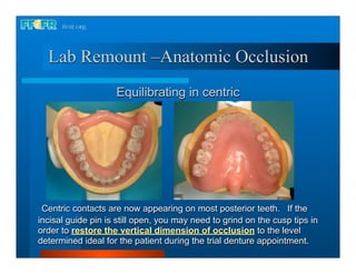 Lab Remount –Anatomic Occlusion
                    Equilibrating in centric




 Centric contacts are now appearing on most posterior teeth. If the
incisal guide pin is still open, you may need to grind on the cusp tips in
order to restore the vertical dimension of occlusion to the level
determined ideal for the patient during the trial denture appointment.
 