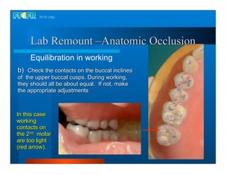 Lab Remount –Anatomic Occlusion
     Equilibration in working
b) Check the contacts on the buccal inclines
of the upper buccal cusps. During working,
they should all be about equal. If not, make
the appropriate adjustments



In this case
working
contacts on
the 2nd molar
are too light           Working position
(red arrow).
 