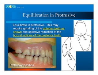 Equilibration in Protrusive
  Equilibrate in protrusive. This may
  require grinding of the anterior teeth as
  shown and selective reduction of the
  buccal inclines of the posterior teeth.




Protrusive position
 