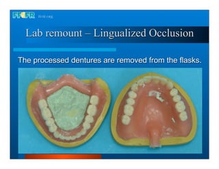 Lab remount – Lingualized Occlusion

The processed dentures are removed from the flasks.
 