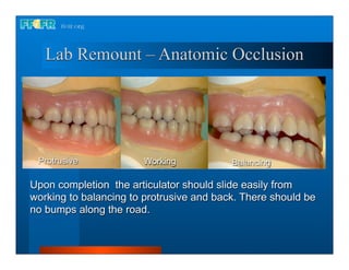 Lab Remount – Anatomic Occlusion




 Protrusive            Working            Balancing

Upon completion the articulator should slide easily from
working to balancing to protrusive and back. There should be
no bumps along the road.
 