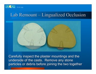 Lab Remount – Lingualized Occlusion




Carefully inspect the plaster mountings and the
underside of the casts. Remove any stone
particles or debris before joining the two together
 