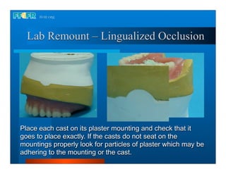 Lab Remount – Lingualized Occlusion




Place each cast on its plaster mounting and check that it
goes to place exactly. If the casts do not seat on the
mountings properly look for particles of plaster which may be
adhering to the mounting or the cast.
 