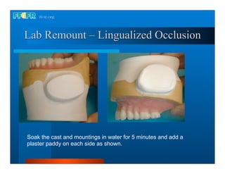 Lab Remount – Lingualized Occlusion




Soak the cast and mountings in water for 5 minutes and add a
plaster paddy on each side as shown.
 