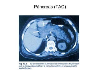 Páncreas (TAC)
 