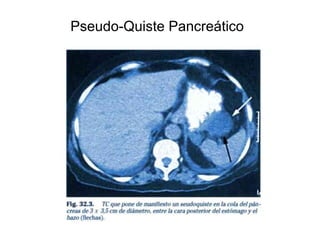 Pseudo-Quiste Pancreático
 
