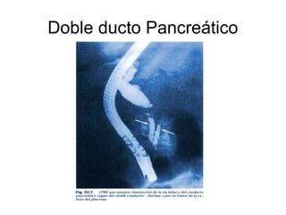 Doble ducto Pancreático
 