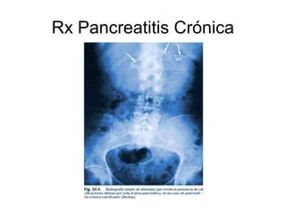 Rx Pancreatitis Crónica
 