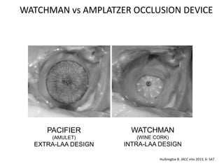 Watchman Device Pdf Yo prefiero el dispositivo Watchman | PDF
