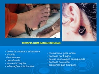 TERAPIA COM SANGUESSUGAS


- dores de cabeça e enxaqueca
                                - reumatismo, gota, artrite
- sinusite
                                - doenças por fungos
 - hematomas
                                - defesa imunológica enfraquecida
- pressão alta
                                - doenças do ouvido
- asma e bronquite
                                - problemas pós cirúrgicos
- inflamações e furúnculos
 