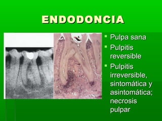 ENDODONCIA
        Pulpa sana
        Pulpitis
         reversible
        Pulpitis
         irreversible,
         sintomática y
         asintomática;
         necrosis
         pulpar
 