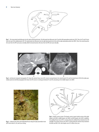New Liver Anatomy Portal Segmentation And The Drainage Vein 2009th ...