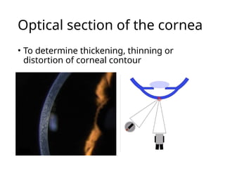 Optical section of the cornea
• To determine thickening, thinning or
distortion of corneal contour
 