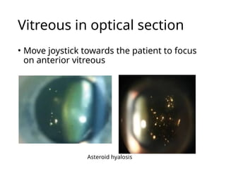 Vitreous in optical section
• Move joystick towards the patient to focus
on anterior vitreous
Asteroid hyalosis
 