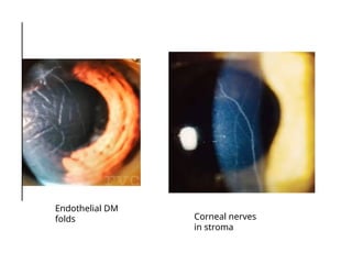 Endothelial DM
folds Corneal nerves
in stroma
 