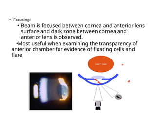 • Focusing:
• Beam is focused between cornea and anterior lens
surface and dark zone between cornea and
anterior lens is observed.
•Most useful when examining the transparency of
anterior chamber for evidence of floating cells and
flare seen in anterior uveitis.
 