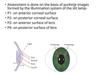 • Assessment is done on the basis of purkinje images
formed by the illumination system of the slit lamp-
• P1- on anterior corneal surface
• P2- on posterior corneal surface
• P2- on anterior surface of lens
• P4- on posterior surface of lens
 