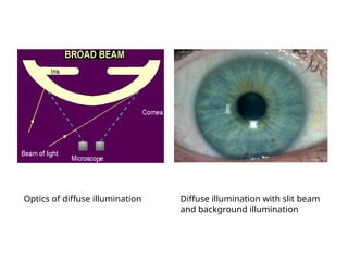 Optics of diffuse illumination Diffuse illumination with slit beam
and background illumination
p
 