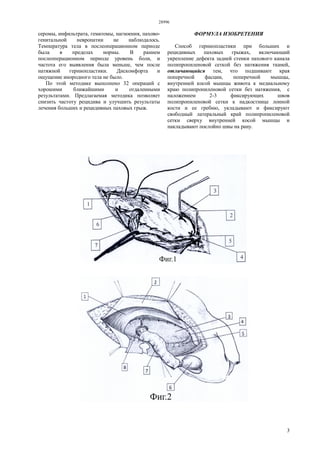 28996
3
серомы, инфильтрата, гематомы, нагноения, пахово-
генитальной невропатии не наблюдалось.
Температура тела в послеоперационном периоде
была в пределах нормы. В раннем
послеоперационном периоде уровень боли, и
частота его выявления была меньше, чем после
натяжной герниопластики. Дискомфорта и
ощущение инородного тела не было.
По этой методике выполнено 32 операций с
хорошими ближайшими и отдаленными
результатами. Предлагаемая методика позволяет
снизить частоту рецидива и улучшить результаты
лечения больших и рецидивных паховых грыж.
ФОРМУЛА ИЗОБРЕТЕНИЯ
Способ герниопластики при больших и
рецидивных паховых грыжах, включающий
укрепление дефекта задней стенки пахового канала
полипропиленовой сеткой без натяжения тканей,
отличающийся тем, что подшивают края
поперечной фасции, поперечной мышцы,
внутренней косой мышцы живота к медиальному
краю полипропиленовой сетки без натяжения, с
наложением 2-3 фиксирующих швов
полипропиленовой сетки к надкостнице лонной
кости и ее гребню, укладывают и фиксируют
свободный латеральный край полипропиленовой
сетки сверху внутренней косой мышцы и
накладывают послойно швы на рану.
 