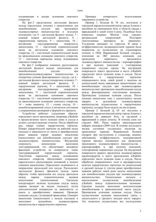 28998
3
соединяющая в центре основания сквозного
отверстия.
На фиг.2 представлена дистальная фаланга
пальца (продольное сечение) с напальчником для
иммобилизации сосудов при чрескожных
эндоваскулярных вмешательствах в исходном
положении, где 6 - дистальная фаланга пальца, 7 -
кожный покров дистальной фаланги, 8 -
хирургическая перчатка, 9 - напальчник, 10 -
внутренняя текстурированная поверхность
напальчника, 11 - эластичный ограничительный
валик на дистальном основании сквозного
отверстия, 12 - эластичный ограничительный валик
на проксимальном основании сквозного отверстия,
13 - эластичная перемычка между основаниями
сквозного отверстия.
На фиг.3 изображено взаимное расположение
дистальной фаланги пальца, напальчника для
иммобилизации сосудов при
чрескожныхэндоваскулярных вмешательствах и
поперечное сечение фиксированного сосуда, где 6 -
дистальная фаланга пальца (поперечное сечение), 7 -
кожный покров дистальной фаланги, 8 -
хирургическая перчатка, 9 - напальчник, 10 -
внутренняя текстурированная поверхность
напальчника, 11 - эластичный ограничительный
валик на дистальном основании сквозного
отверстия, 12 - эластичный ограничительный валик
на проксимальном основании сквозного отверстия,
14 - кожа пациента, 15 - стенка сосуда, 16 -
иммобилизированный сосуд в интактном состоянии
с сохраненными размерами и формой его просвета.
Устройство работает следующим образом:
определяют место прохождения, например a.Radialis
и предполагаемое место пункции кожи и сосуда и
делают соответствующие отметки. После обработки
рук, хирург одевает хирургические перчатки.
Поверх хирургической перчатки на рабочий палец
(пальцы) в зависимости от опыта и приобретенных
ранее навыков хирург надевает напальчник
(напальчники) для иммобилизации сосудов при
эндоваскулярных вмешательствах. Внутренняя
поерхность напальчника выполнена
текстурированной, что обеспечивает надежную
фиксацию устройства на поверхности также
текстурированной хирургической перчатки.
Эластичная перемычка между основаниями
сквозного отверстия обеспечивает сохранение
параллельного расположения оснований в момент
одевания напальчника. Определяют подвижность и
направление продольной оси сосуда. Располагают
дистальную фалангу (фаланги) пальца таким
образом, чтобы продольная ось сосуда проходила
между парами ограничительных валиков
напальчника (напальчников). Тактильно
контролируют наличие пульсации сосуда между
парами валиков на пальце (пальцах), путем
дополнительной компрессии (в зависимости от
опыта и приобретенных навыков). Проводят
пункцию сосуда с установкой проводника. Снимают
напальчник (напальчники) с пальца (пальцев) и
выполняют дальнейшие эндоваскулярные
вмешательства в хирургических перчатках.
Примеры конкретного использования
заявляемого устройства.
Пример 1. Больная В, 58 лет, поступила в
городской кардиологический центр города Алматы с
жалобами на сжимающую боль в области сердца с
иррадиацией в левой плечо и руку. Подобные боли
появились впервые. Многие годы страдает
артериальной гипертензией. Регулярно
гипотензивные препараты не принимает.
Ухудшение связывает со стрессом. В связи с
неэффективностью медикаментозной терапии была
направлена из поликлиники на стационарное
лечение в ГКЦ. Выраженный болевой синдром,
изменения на ЭКГ явились показание для
проведения первичного чрескожного
эндоваскулярного вмешательства - коронарографии
и при наличии показаний - стентировния
пораженных сосудов сердца. На внутренней
поверхности левого предплечья в месте a.Radialis
определено место пункции кожи и сосуда. После
обработки в хирургических перчатках
операционного поля, левой рукой с надетым на
указательный палец заявляемым напальчником для
иммобилизации сосудов при эндоваскулярных
вмешательствах произведена иммобилизация сосуда
между фиксирующими эластичными валиками.
Произведена успешная пункция сосуда. После
пункции напальчник снят с указательного пальца
хирурга и дальнейшие эндоваскулярные
вмешательства осуществлены в хирургических
перчатках, которые были надеты на кисти ранее.
Пример 2. Больной Д, 65 лет поступил в
городской кардиологический центр города Алматы с
жалобами на давящую боль за грудиной с
иррадиацией в левую лопатку. В течение семи лет
страдает ИБС. Ранее перенес трансмуральный
инфаркт миокарда (2009 год). В течение последнего
месяца состояние ухудшилось несмотря на
проводимую терапию. Выраженный болевой
синдром при поступлении в стационар, анамнез
заболевания, неэффективность консервативной
терапии явились основанием для проведения
чрескожного эндоваскулярного вмешательства -
коронарографии и, при наличии показаний,
стентирования пораженных сосудов. На внутренней
поверхности правого предплечья эндоваскулярным
кардиохирургом в месте прохождения a.Radialis
определено место пункции кожи и сосуда. После
обработки операционного поля в предварительно
надетых хирургических перчатках на указательный
и средний пальцы (с учетом ранее приобретенных
навыков работы) левой руки надеты напальчники
для иммобилизации сосудов при эндоваскулярных
вмешательствах. Указательным пальцем с
напальчником осуществлена иммобилизация
a.Radialis между ограничительными валиками.
Средним пальцем выполнена дополнительная
иммобилизация в проксимальной части сосуда.
Произведена успешная пункция сосуда. После
осуществления пункции напальчники сняты с
указательного и среднего пальцев кисти хирурга.
Это позволило осуществлять все последующие
 