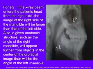 Errors in Cephalometry | PPTX