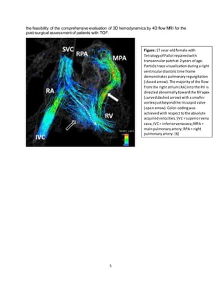 5
the feasibility of the comprehensive evaluation of 3D hemodynamics by 4D flow MRI for the
post-surgical assessment of patients with TOF.
Figure:17 year-oldfemale with
Tetralogyof Fallotrepairedwith
transannularpatchat 2 years of age.
Particle trace visualizationduringaright
ventriculardiastolictime frame
demonstratespulmonaryregurgitation
(closedarrow).The majorityof the flow
fromthe rightatrium(RA) intothe RV is
directedabnormallytowardthe RV apex
(curveddashedarrow) withasmaller
vortex justbeyondthe tricuspidvalve
(openarrow).Color-codingwas
achievedwithrespecttothe absolute
acquiredvelocities.SVC=superiorvena
cava; IVC= inferiorvenacava;MPA =
mainpulmonaryartery;RPA = right
pulmonaryartery. [6]
 