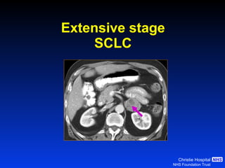 Extensive stage SCLC 
