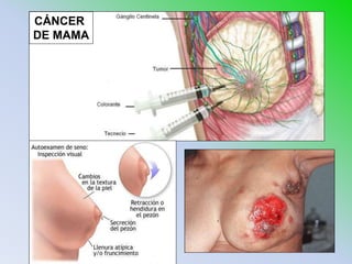 CÁNCER
DE MAMA
 