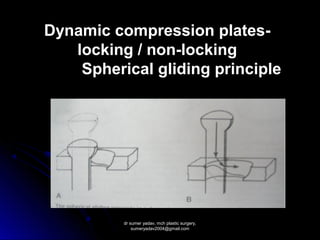 mandibular fractures | PPT