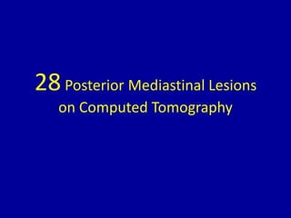 28Posterior Mediastinal Lesions
on Computed Tomography
 