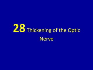 28Thickening of the Optic
Nerve
 