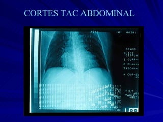 CORTES TAC ABDOMINAL 