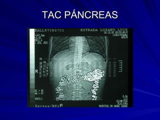 TAC PÁNCREAS 