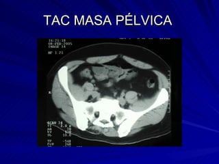 TAC MASA PÉLVICA  