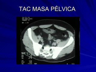 TAC MASA PÉLVICA  