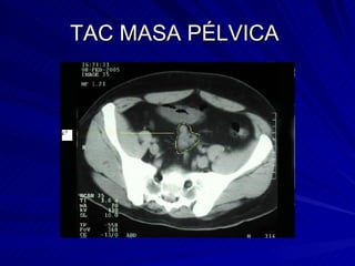 TAC MASA PÉLVICA  
