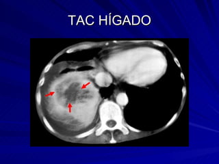 TAC HÍGADO 