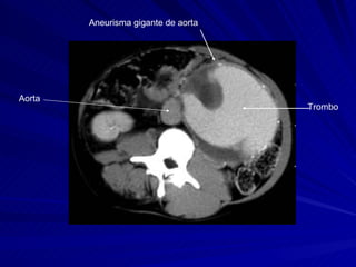Aneurisma gigante de aorta Trombo Aorta 