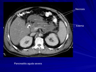 Pancreatitis aguda severa Necrosis  Edema 