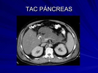TAC PÁNCREAS 