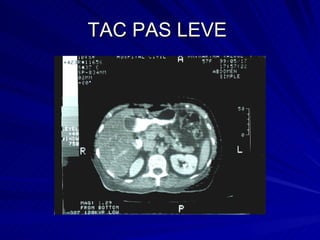 TAC PAS LEVE  
