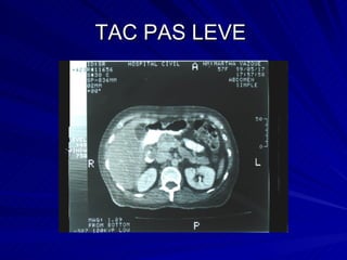 TAC PAS LEVE  
