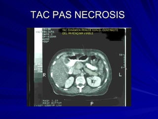 TAC PAS NECROSIS  