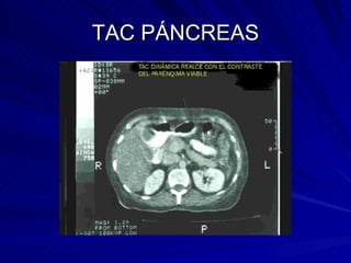 TAC PÁNCREAS 